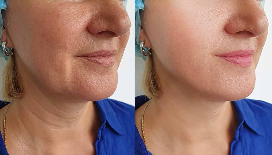 LASER FACIAL RESURFACING